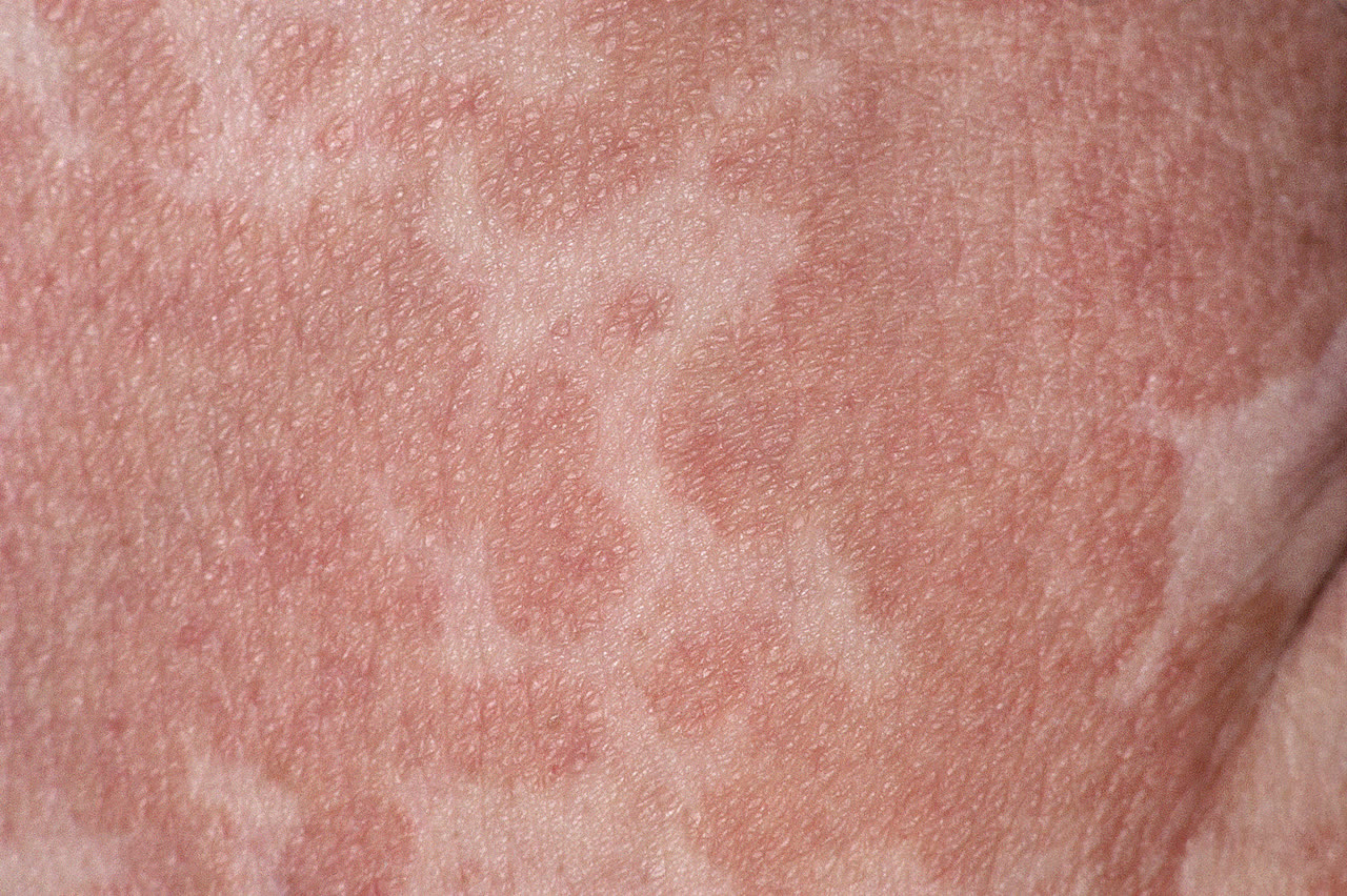 Pityriasis versicolor: lysere og mørkere pletter med fin skælning på ryg og skuldre
