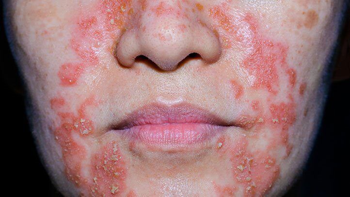Svær perioral dermatitis med rødme og afskalning omkring mund og næse